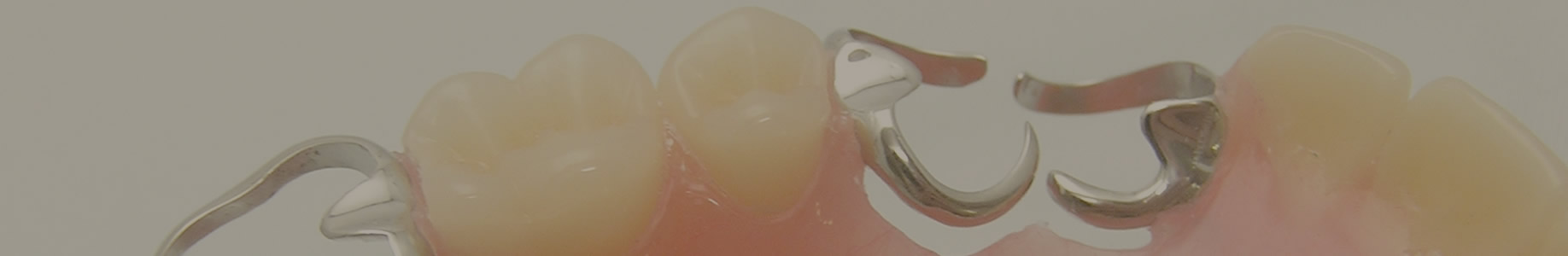 入れ歯(義歯)治療