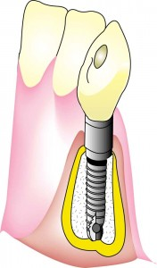 セントラル歯科　インプラント